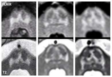 JackyGanguly's tweet photo. "Closed Omega Sign" in AMACR deficiency #neurotwitter https://t.co/IETnlrcNTV #Pristanicacid
- Ataxia, dystonia
- Retinitis pigmentosa
- Stroke-like episodes
- Neuropsych
- Cataract
- Neuropathy/ Spastic-ataxic 
- Liver fibrosis, Cirrhosis https://t.co/GVZ2pUYUxO