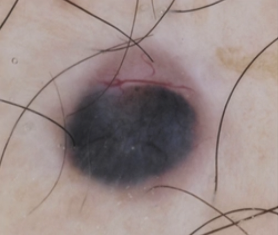 DermMarianne's tweet photo. 💡Dermoscopic clue: heavily pigmented BCC vs nodular melanoma
🔵BCC: vessels easily visible -typically around tumor islands- & no black color (left)
⚫️NM: vessels less commonly seen & black color common - due to melanin within the epidermis - (right)
#dailyscope https://t.co/gjzxnUsDax