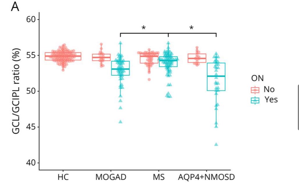 andreuvilaseca7's tweet photo. Great OCT study from @HopkinsMedicine @ESotirchos
Although AQP4+NMOSD causes worse optic neuritis outcomes than MOGAD, ganglion cell loss from retrograde degeneration seems similar, both greater than #MultipleSclerosis!
👀 So what drives worse vision in AQP4+NMOSD?
#NMOSD #MOGAD https://t.co/CI9TVDQjg2