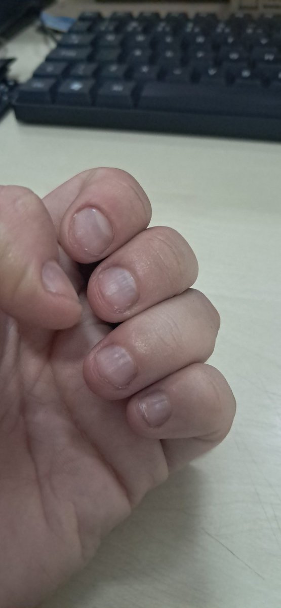 Tonioli5's tweet photo. Quando eu finalmente deixei ela crescer... foi só uma semana de ansiedade e com a depressão bater na porta e ela voltou a essa merda

Que odioooooo https://t.co/xjBnOxYtwJ