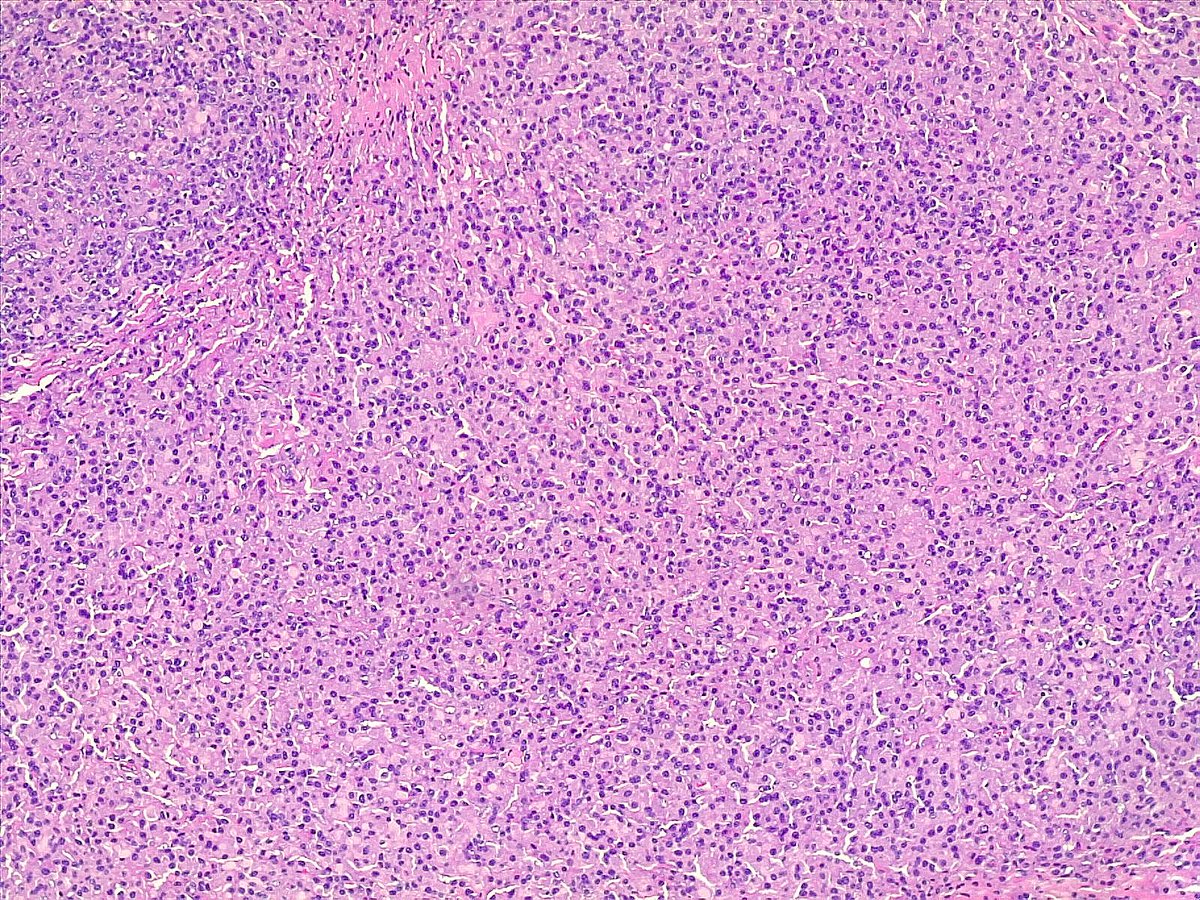 ariabdullah1978's tweet photo. A 3.5cm cervical lymph node, was excised during a total thyroidectomy. This image represents a section from that lymph node, what do you think is the Dx? https://t.co/KoXdPn3ULv