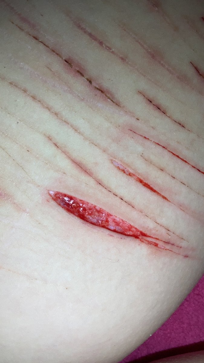OllySchrodinger's tweet photo. First 2 deep styro and then beans.
I lowk got those styro infected and finally decided to get antibiotic ointment and bandaids, Those beans are my first ones. #styrotwt #beanstwt #sh #slitwt 
FAKE sfx!! https://t.co/1Kr5YRMT8R