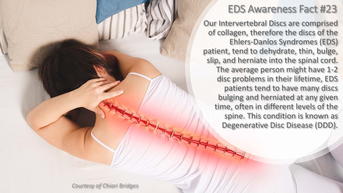 ChiariBridges's tweet photo. EDS Awareness Fact #23

For more on EDS and DDD: https://t.co/9gk0MvhH3m.

• Check out our website: https://t.co/2PKALj9vq8

#ChiariBridges 
#WorthTheFight 
#WTF 
#EDSawareness2026 
#EDSawareness 
#EhlersDanlosSyndrome https://t.co/DXLrcw9HLQ