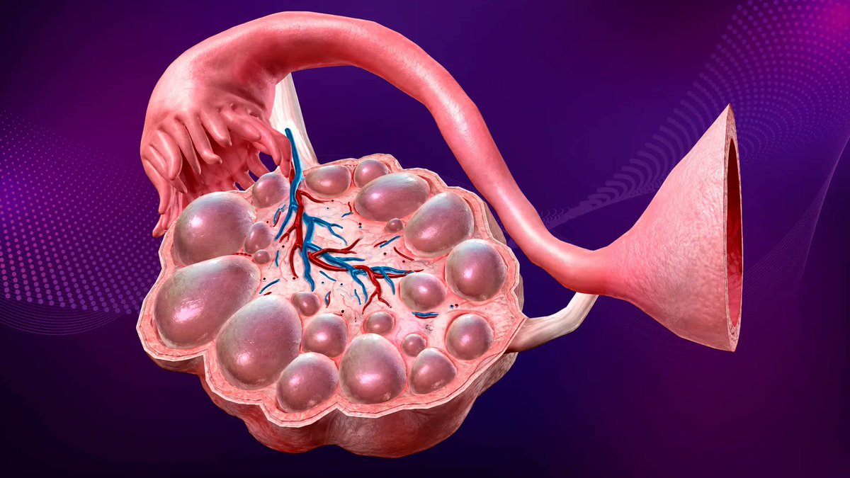 ginexeltis's tweet photo. GineNews 🗞️
¿Adiós al “Síndrome de Ovario Poliquístico”? El nuevo consenso global propone redefinir la enfermedad..
#SOP #Endocrino #Metabólico #Inflamatorio #Neuroendocrino
ver mas https://t.co/j4HW1hCAuW https://t.co/4TBkpHbpTZ