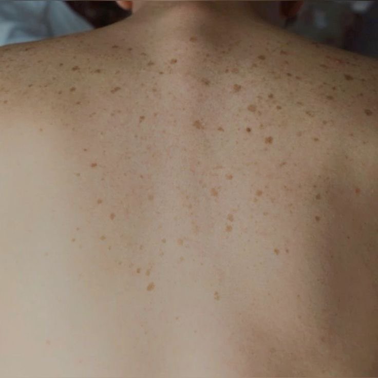 Smpetoms's tweet photo. - SCARS i almost forgot this one
a lot of scars &amp; freckles
(10/10) https://t.co/gVCyK8jeiy