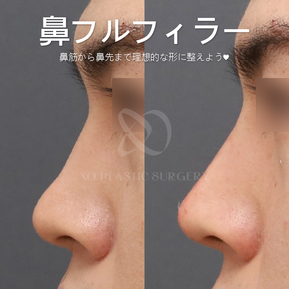 xops_jp's tweet photo. 【 XO 鼻フルフィラー👃🏻✨】
鼻筋から鼻先まで理想的な形に！

高額な手術❌
手軽な施術⭕️

長いダウンタイム🙅🏻‍♀️
短いダウンタイム🙆🏻‍♀️

📢5~6月中施術の場合モニター
特別割引価格でのご案内です❤️‍🔥

公式LINEへお問い合わせください
📩https://t.co/9QOhaH304L

#鼻ヒアル #ヒアルロン酸 #プチ整形 https://t.co/bFSm0ExCf7