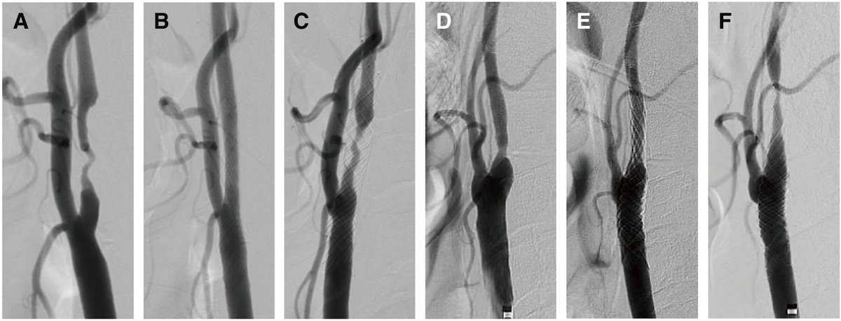 JNET(Journal of Neuroendovascular Therapy) tweet media