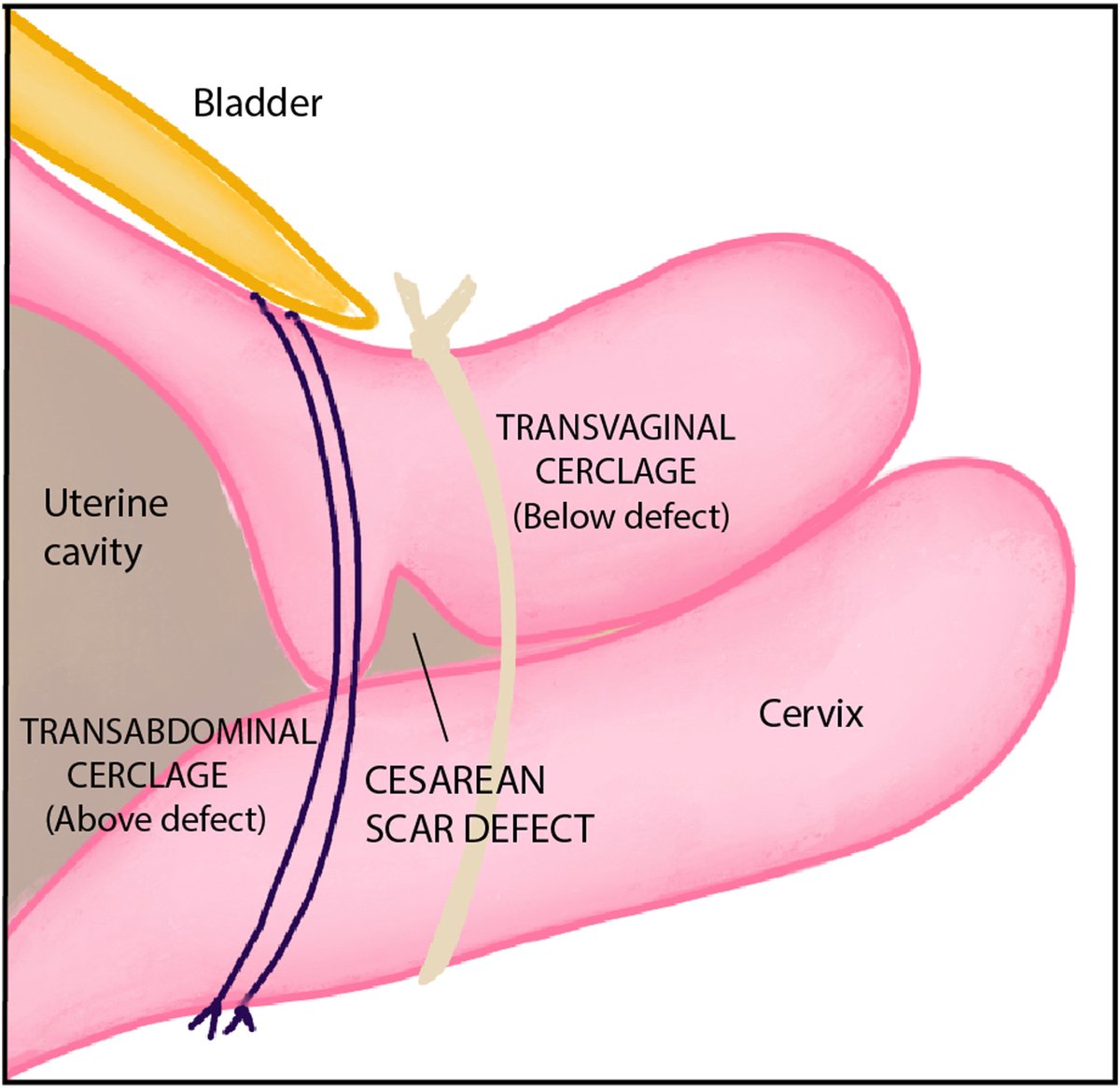 AJOG_thegray's tweet photo. Cesarean scar defect in the cervix, corresponding cerclage height and level of the sphincter: further evaluation is needed to verify whether either approach has a benefit https://t.co/AyW6fsJ8vP https://t.co/vu7P1ZOpxL