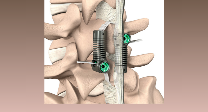 ODTmagazine's tweet photo. Empirical Spine’s motion-preserving #spinalfusion alternative debuts in U.S.: https://t.co/dUJlq0nTpo https://t.co/NMcE29MMR8