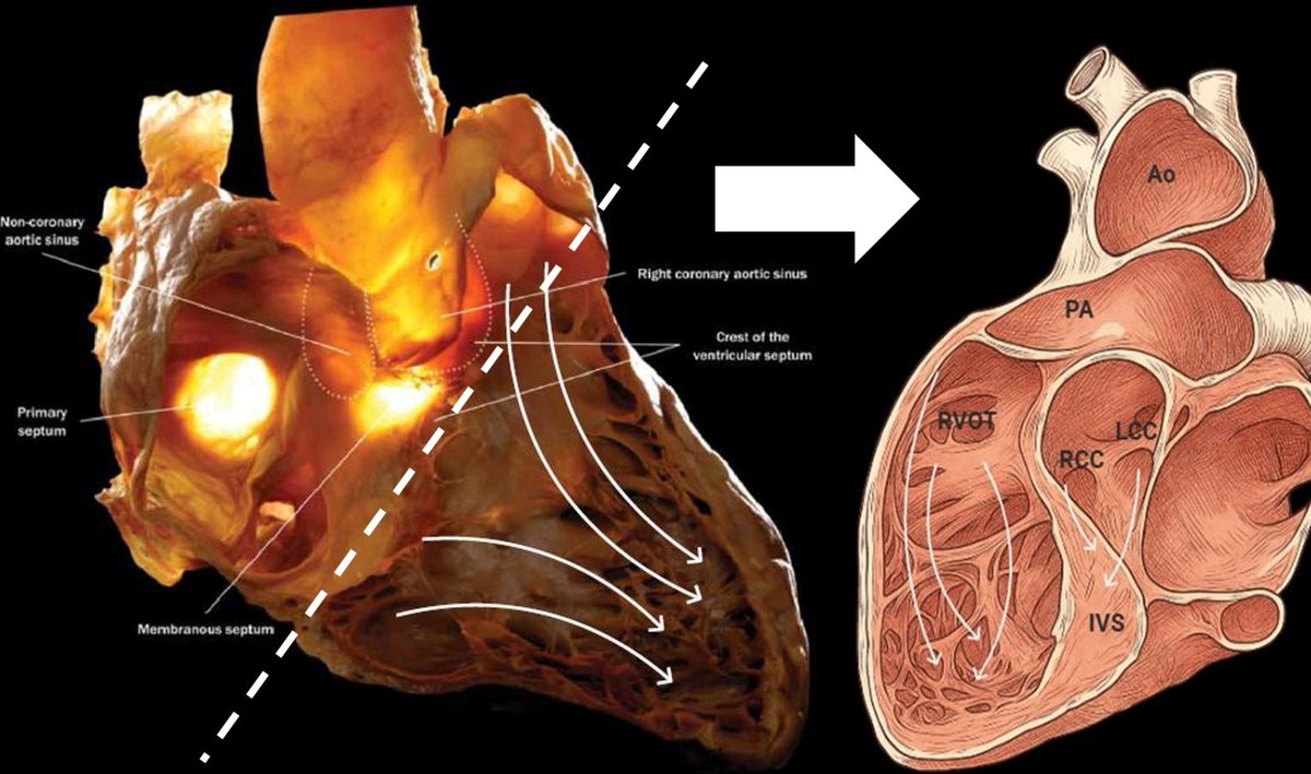 DrJawadi_EP's tweet photo. In an era of new energies &amp; catheters, we went back to the ECG.
The notch in OT PVCs isn’t just morphology, its timing grounded in a mechanistic framework predicts the site of origin. Full data now out in @JElectrocardiol @HappyEP @YigitYilanci @umutinevi https://t.co/vsrPSjOmt2 https://t.co/NilVeCieH4