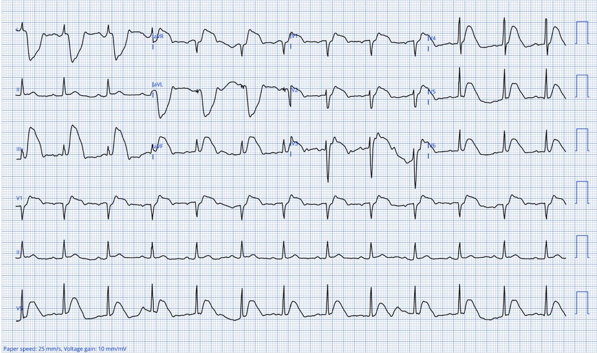 DrMarkHellerman's tweet photo. 88F presents w/ substernal chest discomfort. What’s the diagnosis? Answer w/ 2 min video explanation:  https://t.co/Wzrkg3BQlX @JACCJournals #JACC #ECG #CardioTwitter #FOAMed https://t.co/890fd5JFv0
