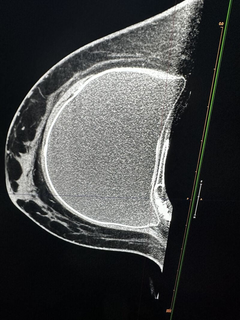 KoningCorp's tweet photo. Innovation that changes everything for patients with implants.

Compression-free. No touch. Pure gravitational positioning.

In just one shot (7–10 seconds), we can clearly visualize the tissue between the implant and the chest wall — without displacing the implant.

No more added views. No extra radiation. No discomfort.

This is the future of breast imaging.

Learn more at https://t.co/f517vMoJfD!
