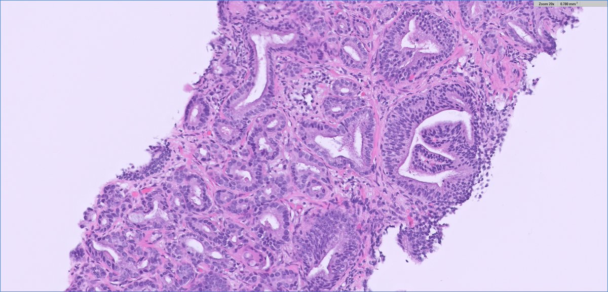 slusagar's tweet photo. #GUpath prostate:
3+4 with glomerulation?
✔️PIN4 #IHCpath
occasionally HGPIN foci can mimic gloms https://t.co/ADd6wPcNq2
