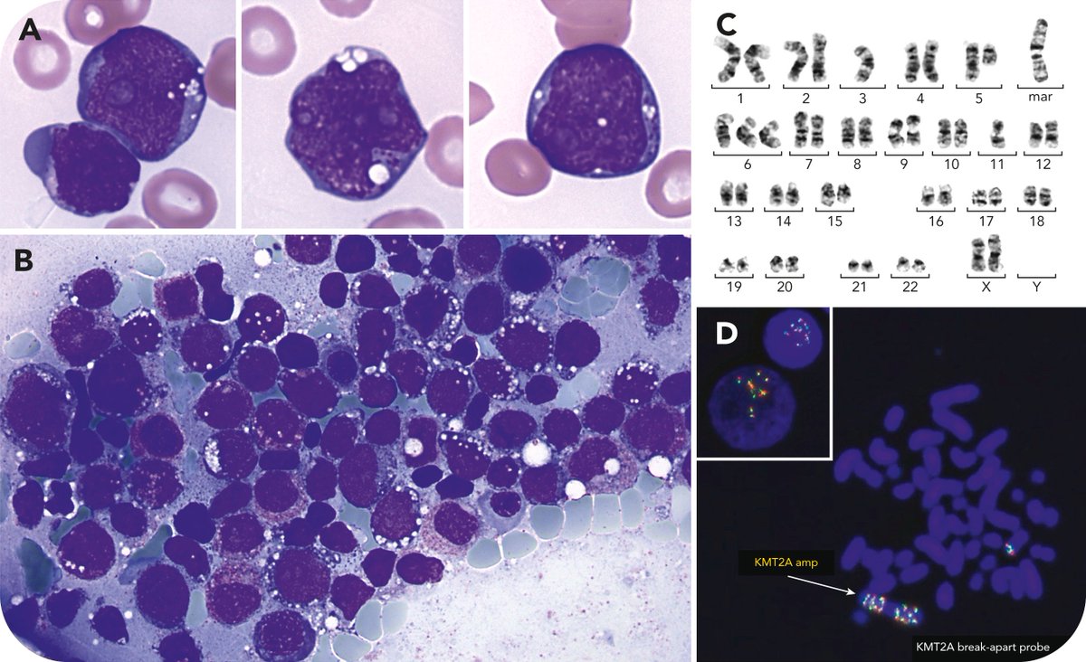 smbenlazar's tweet photo. Shrouded in a starry sky: a case of AML-MRC with KMT2A amplification mimicking Burkitt-like morphology https://t.co/Blrr8mdh6m https://t.co/UnV9rtqqD5