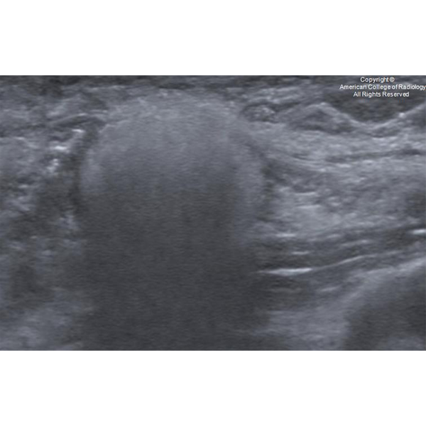 RadiologyACR's tweet photo. A 53-year-old female presents with breast pain and breast hardness. #ACRCaseinPoint https://t.co/KE20NDUb0I https://t.co/cXBP5wUavJ