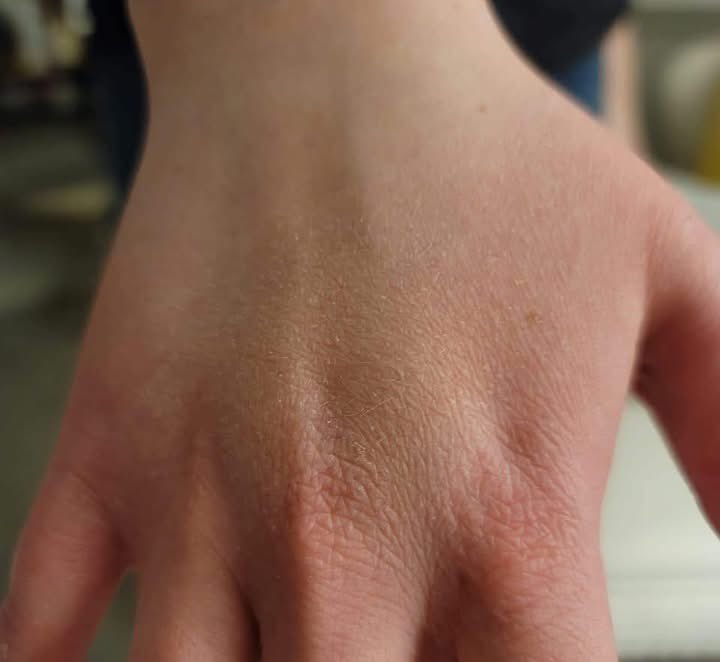 BrittLesley3's tweet photo. Gaylene: My daughter washes her hands all the time (it's a OCD thing). I put a Kick It patch on her and noticed that she didn't wash her hands as much...big difference before/after. Too much washing can cause problems for your skin and health. #superpatch @revspatches.com https://t.co/A4dVCsTyRm