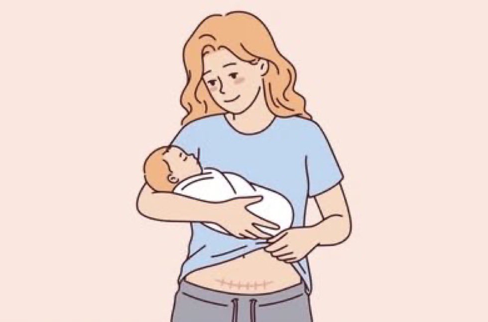 Dr_mahaalnemer's tweet photo. اسئلة بعد العمليه القيصري:

🔸متى يرجع الرحم لطبيعته؟
-بعد الاربعين

🔸متى امارس الرياضه؟
▪️المشي مباشره بعد العمليه
▪️في الاربعين: المشي والسير
▪️شد البطن بعد شهرين  

🔸متى استحم؟
-مباشره متى مارغبت ��عد العمليه

🔸متى اطلع درج؟
-مباشره متى مارغبت بعد العمليه

🔸متى البس المشد؟
-خلال اسبوع (مشد خفيف)

🔸متى اخذ  حبوب منع الحمل؟
-٢١يوم نفاس

🔸متى اركب لولب؟
-بعد الاربعين

🔸متى الحمل القادم؟
-بعد ١٨شهر