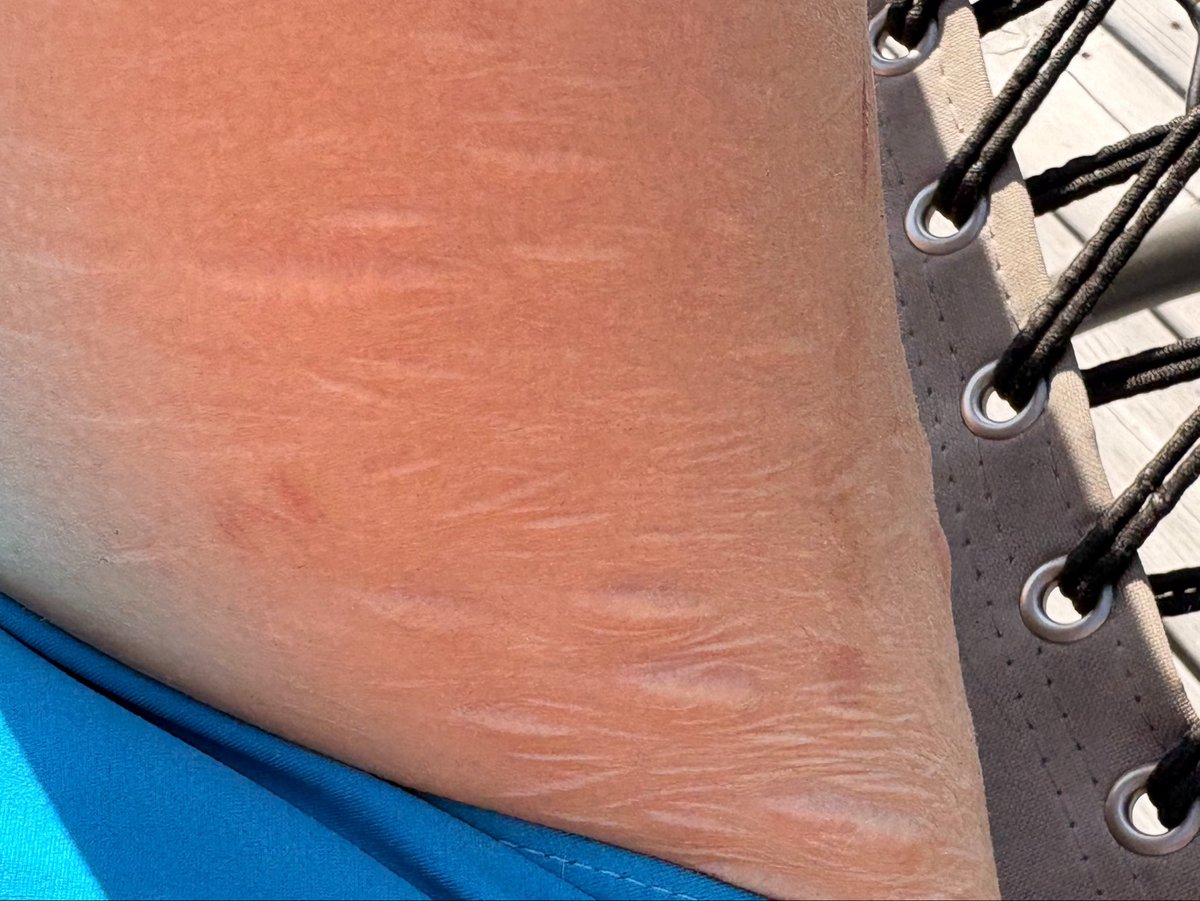 bassvicitm's tweet photo. Scars  look  white  cuz  im  tanned 🤦‍♀️ https://t.co/OOne0bikOA