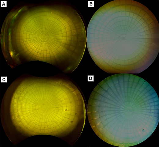 ARVOtvst's tweet photo. Un Chul Park, Saram Lee et al. from Seoul National University Hospital establish a quantitative correction database for peripheral distortion in ultra-widefield fundus imaging across varying axial lengths, media, and posterior staphyloma variations.
https://t.co/AK2umCBypl https://t.co/cxOgdNe9Uf