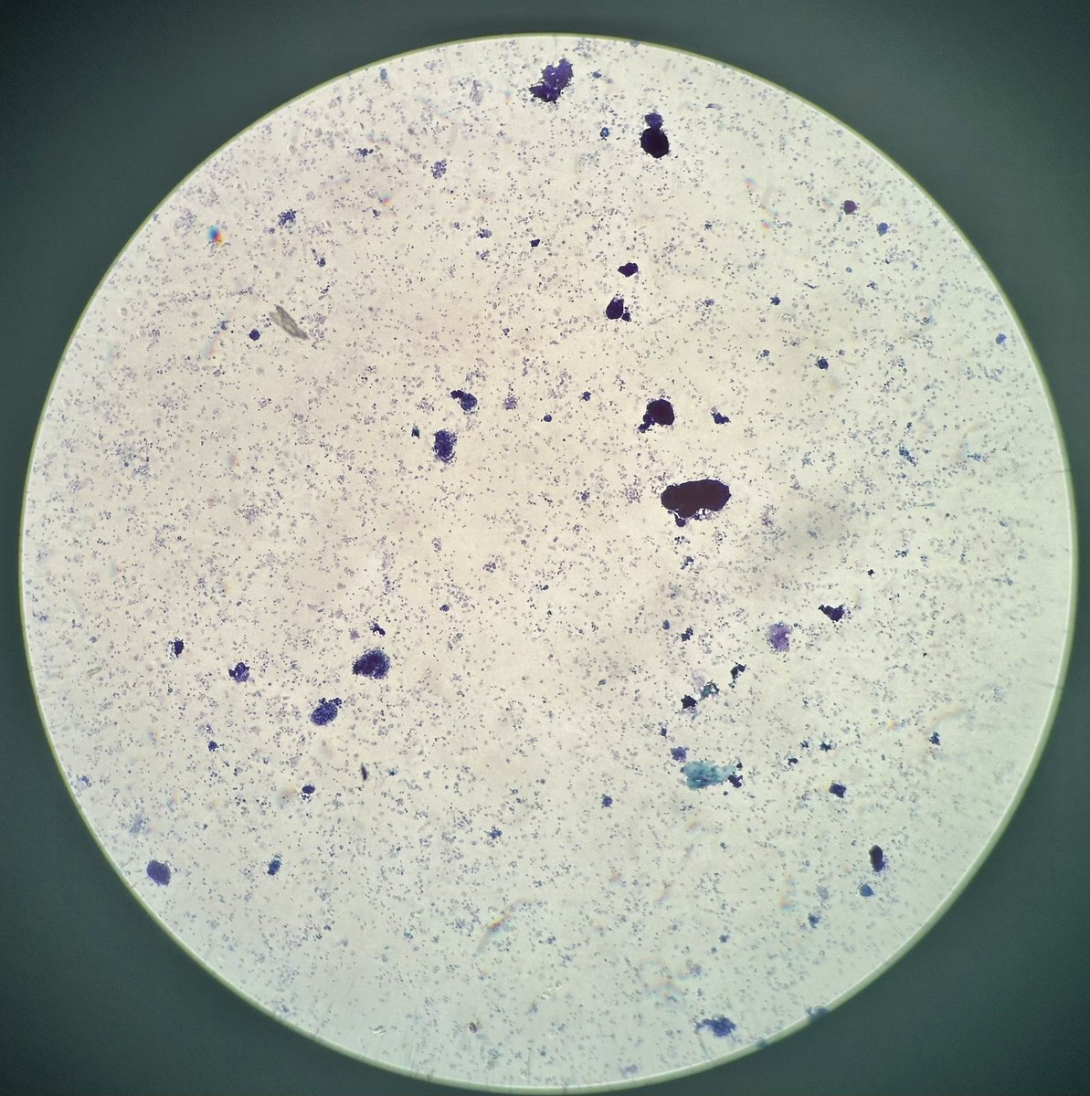 lesgobeybi's tweet photo. 76-year-old male with a history of high-grade urothelial carcinoma of the bladder. Cytology specimen and cell block prepared from a left renal pelvic washing.
#PathTwitter #Pathology #Cytology #UrinaryCytology #UrothelialCarcinoma #GUPath #CellBlock #PathX #MedTwitter https://t.co/7womTwqqXg