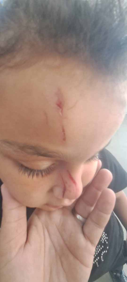 abdullah_murad2's tweet photo. My daughter Maha was injured while fleeing from the sound of bombing. The wounds on her face need treatment and healing cream to reduce scarring. Any support or share would mean a lot to us. 🙏💔
🔗 [Your link here] #Gaza #HelpMaha #Donate #ChildrenOfGaza https://t.co/1GczELOAdO