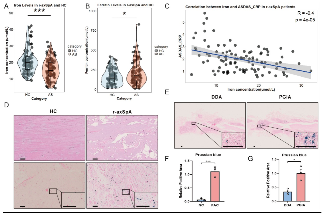 Nellziade's tweet photo. 🦴 Does TNF-driven iron overload fuel bone formation in r-axSpA? 

Translational study: Iron accumulates in fibroblasts, driving ECM &amp; osteophytes

#POS0080 #EULAR2026 @RheumNow https://t.co/cnP80pbbmE