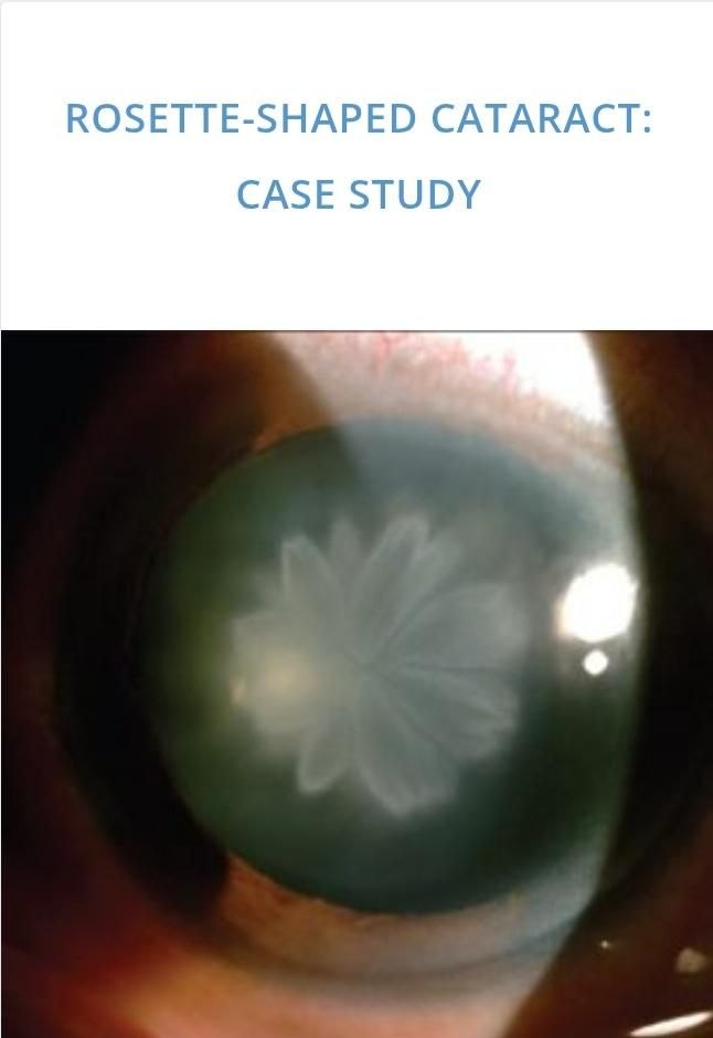skirrow82's tweet photo. While studying, these cases reminded me of koyuki 
Rosette cataract and festooned pupil🌸 https://t.co/P9LxJha7MJ