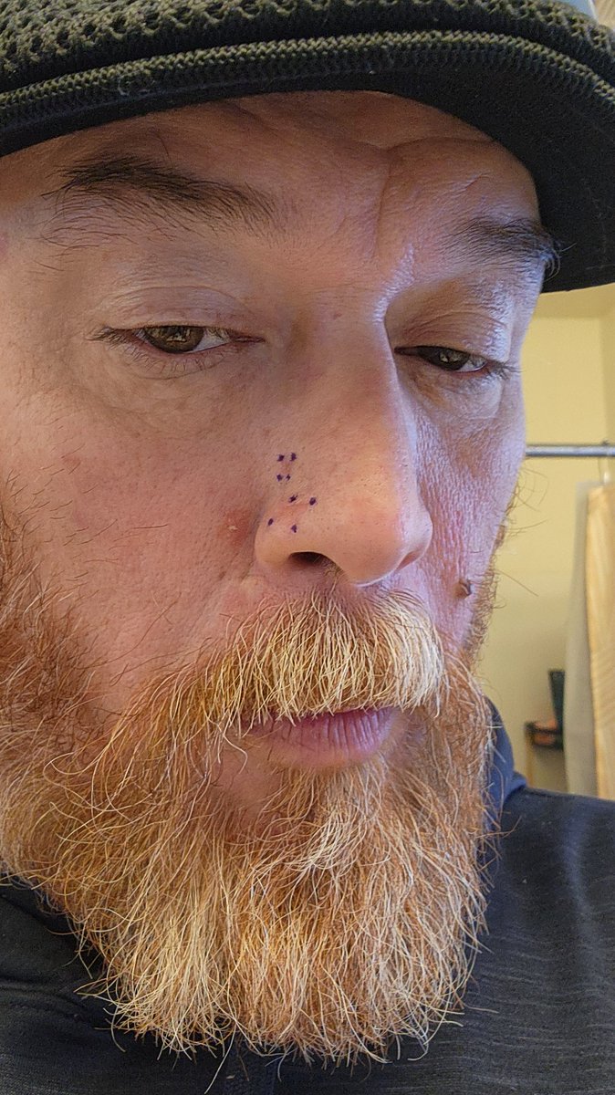 bignellyhendo41's tweet photo. #fuckcancer mohs surgery is on deck.  Sun is killing us all. Please wear the sunscreen and reapply.  Down in the dumps for a bit. Cheer me up https://t.co/TAv9RPOHXk