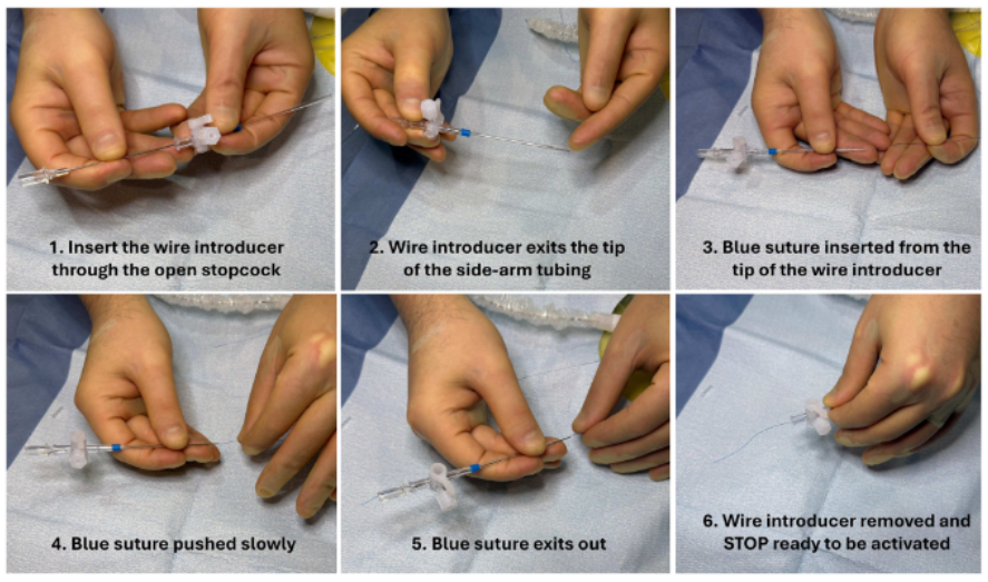 gbiondizoccai's tweet photo. Another acronym worth remembering? The Side-arm Technique On Perclose (STOP) for large-bore vascular hemostasis https://t.co/22fym9NMY9 @ccijournal https://t.co/XDpVhaxNrB