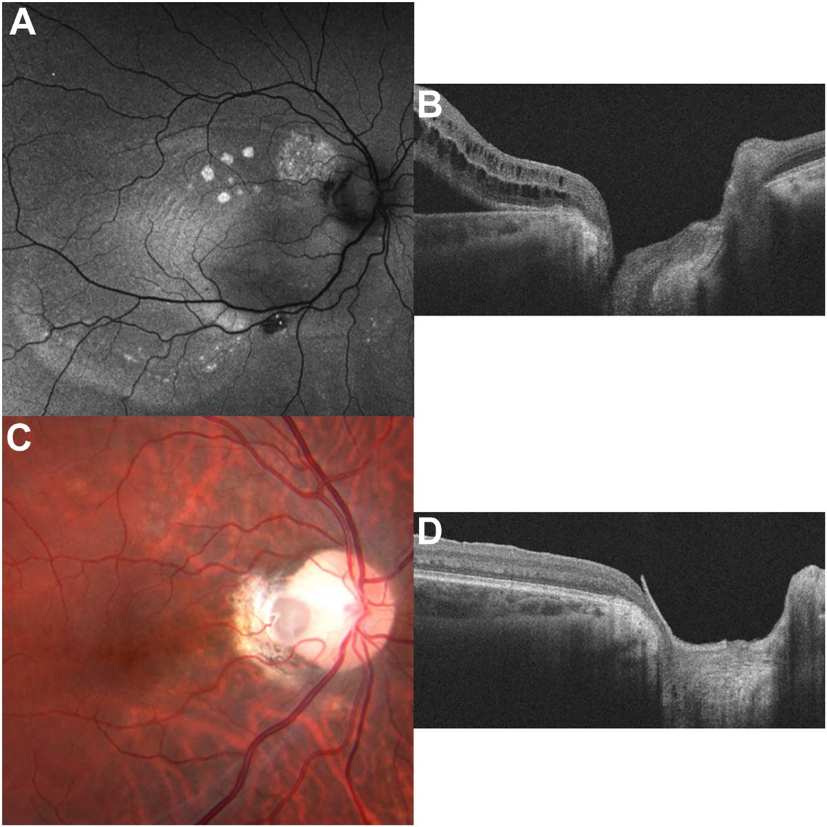 AAOjournal's tweet photo. A 19-year-old man presented with decreased vision after 3 prior vitrectomies for optic nerve pit maculopathy at another hospital including such treatments as internal limiting membrane peel, endolaser to optic nerve pit edge, and C3F8 gas use. Best-corrected visual acuity was 20/100. Fundus autofluorescence showed multiple areas of prior and current subretinal fluid (A), and OCT showed optic disc excavation with intraretinal fluid and subretinal fluid (B). He underwent pars plana vitrectomy with amniotic membrane (AMT) graft to cover the pit and SF6 gas. Postoperative imaging showed fluid resolution and good graft position; best-corrected visual acuity improved to 20/50. One-year postoperative OCT confirmed stable AMT position without recurrent fluid (C, D).
https://t.co/H4oS8qQpLP
#ophthalmology #retina