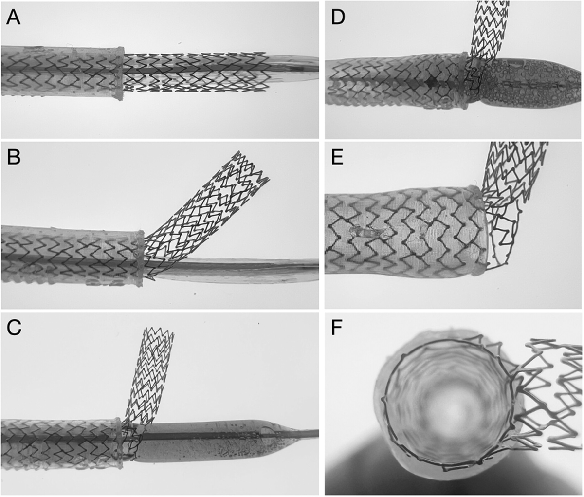 gbiondizoccai's tweet photo. Facing excessive ostial stent protrusion? Then consider the Side Flap technique, which offers a controlled and reproducible alternative strategy when true-lumen access is not achievable or fails https://t.co/LLp4fOujqW @ccijournal https://t.co/El1jUrXfI2
