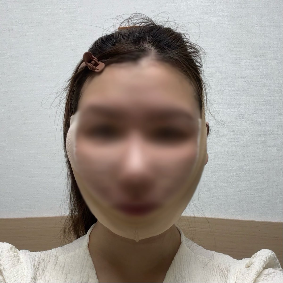 ___rinrin_00's tweet photo. DUさんで顔の脂肪吸引/ペリカン手術/糸リフトを受けてきました。手術当日レビュー🌟 https://t.co/QuijNGE85c