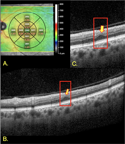 ARVOtvst's tweet photo. Amani A. Fawzi et al. from the  Feinberg School of Medicine validate retinal ischemic perivascular lesions (RIPLs) as an  OCT biomarker for vision-threatening diabetic retinopathy, using ultra-widefield fluorescein angiography as the grading reference
https://t.co/4wGNvmQHOs https://t.co/fmlXGaWdt4