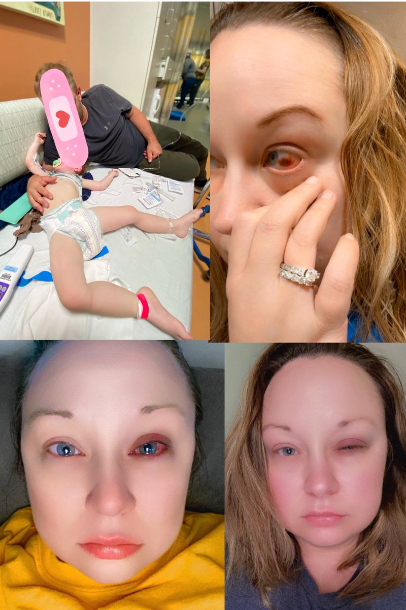 EricawithaC13's tweet photo. 5 years ago, I made the hardest decision of my life.
🛑I didn’t want the shot.
🛑I wasn’t lining up for it.
🛑I wasn’t excited about it.

My son was going into repeated comas, and the health insurance and benefits helping keep him alive was being threatened. I was mandated. My son became a weapon used against me. 

So I made a choice no parent should ever have to make.

I chose my son’s life over my own.

The government told us these products were “safe and effective vaccines.”
They insisted serious side effects were rare & mild. Just a sore arm.

We were told if something went wrong, there is a system to take care of the injured.

The pharmaceutical companies were given complete liability protection because the government promised Americans would not be left behind.

That promise was broken. It was as all lies. Lies now confirmed by Congress, Agency officials and our own HHS Secretary.

Within 24 hours of my injection, I began losing vision in my right eye.

What followed were years of neurological problems, brain inflammation, hearing loss, chronic pain, fatigue, heart issues, and a daily fight just to keep going.

Five years later, I’m still fighting.

Not just for myself. For every person who did what they were told. For every family that trusted the promises. For every injured American who discovered too late that the safety net wasn’t there.

Today, React19 and Aaron Siri released a public submission documenting what thousands of injured people have been trying to tell our government for years.

My story is part of this record.

For 5 years they hoped we’d disappear.

For 5 years they hoped we’d get tired.

For 5 years they hoped we’d stop talking.

We didn’t. I didn’t. I won’t. 

And we’re not done. Not even close. I’m just getting started. 

Comment and share if you are someone injured or bereaved and would like an option to pursue legal action too. We need to to let them know how many of us there are ❤️‍🩹

Read the latest: 🔗 in comments below
