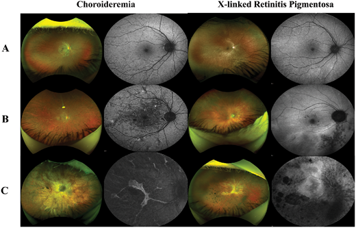 ARVOtvst's tweet photo. Stephen H. Tsang et al. from  Columbia University Irving Medical Center characterize and compare structural and functional outcomes in female carriers of choroideremia and RPGR-associated X-linked retinitis pigmentosa (XLRP).
https://t.co/bfKw0TSYjc https://t.co/OfaptPhOe1