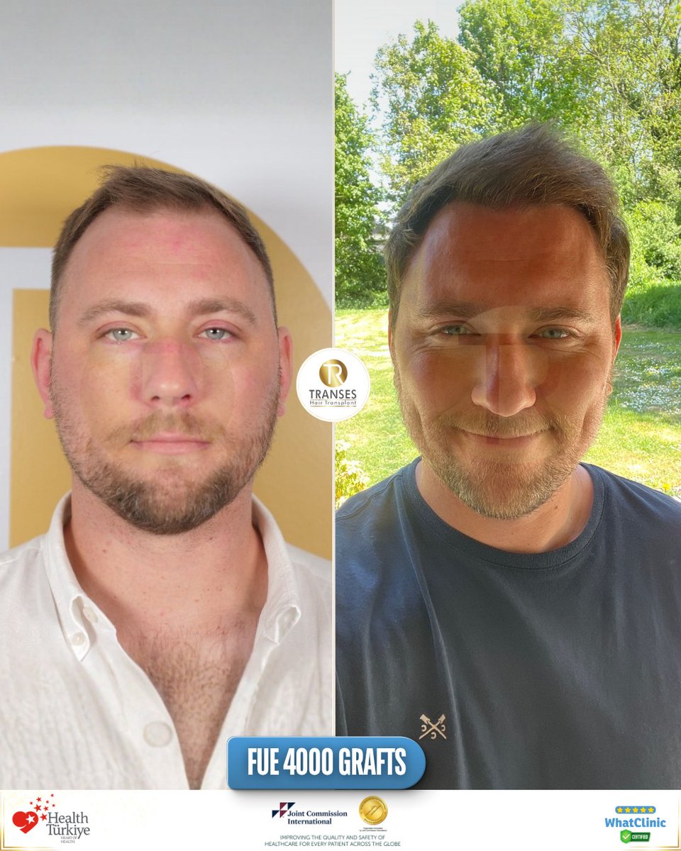 transeshair's tweet photo. This hair transplant operation was performed at Istanbul Tema Hospital BHT Clinic.
15 years of experience with a 4.9 ⭐ WhatClinic rating.
FUE • DHI • HYBRID • PRP
Natural results, professional care.

#YourJourneyYourTransformation
#TransesHairTransplant
#FUE #DHI #PRP https://t.co/CTXd6EgbIp