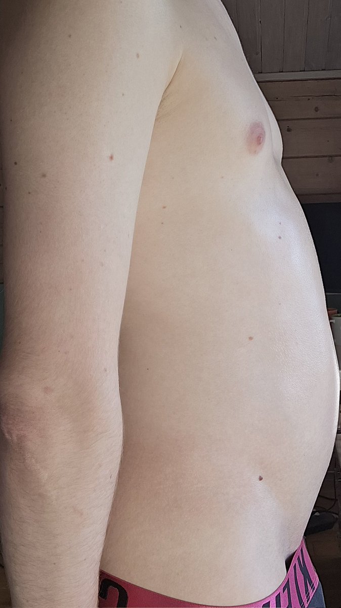 TimTim115940341's tweet photo. My belly got massively inflated and covered in shiny oil... Look how tight, round and glossy it became 🎈✨
Feels so fucking full and stretched... Who wants to pump me even bigger? 😈
#BellyInflation #InflatedBelly #BloatedBelly #InflationFetish https://t.co/0MkPOlsQTC