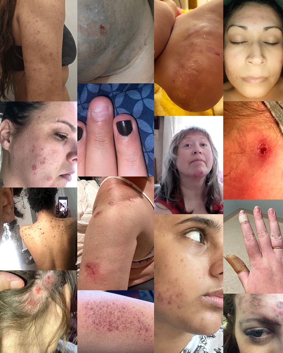 PickingMeFdn's tweet photo. Share your story with the community and join the countless others who are smashing stigma surrounding #SkinPicking.

Visit https://t.co/gXNTTfGmZg to get started.

#Dermatillomania #SkinPickingDisorder #BFRB #OCD #MentalHealth https://t.co/PojP6iuxW9