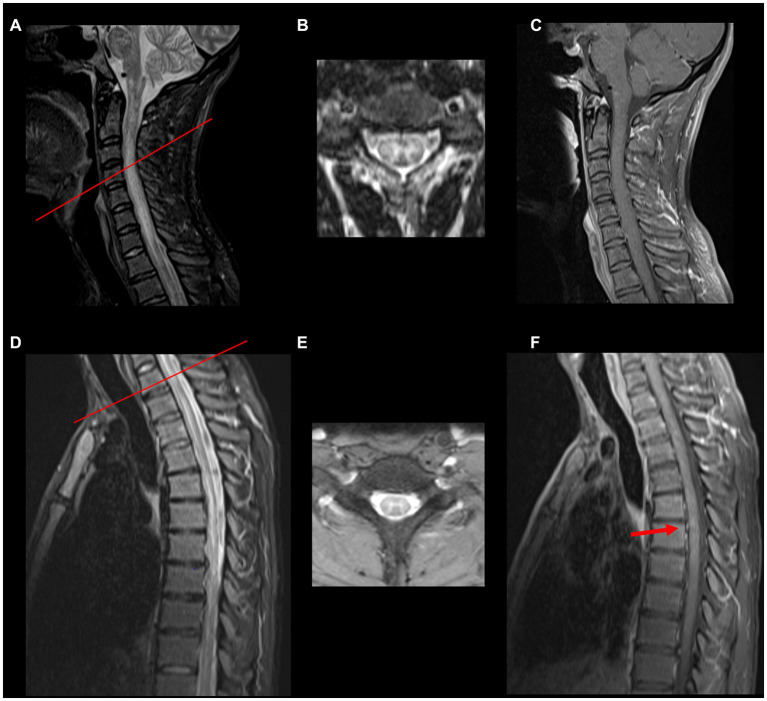 DocNavarrow's tweet photo. 🥸A previously healthy adult presents with acute to subacute bilateral lower-extremity weakness, sensory disturbances, and urinary dysfunction following a recent infectious illness. Symptoms rapidly progress over days, prompting spinal MRI.

🥼What is your leading differential? https://t.co/v7lR5k1VVR