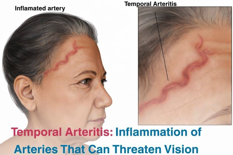 AB_drmd's tweet photo. 🚨🚨🚨ايش الـ gold standard لتشخيص ال Temporal Arteritis؟؟ https://t.co/TZWiF2xMDw