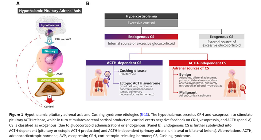 sociedadSEEN's tweet photo. Measuring cortisol in Cushing syndrome: diagnosis, monitoring, and cortisol circadian rhythm improvement
* Actualmente, la utilidad de evaluar el ritmo circadiano del cortisol en pacientes individuales durante el diagnóstico y tratamiento del #Cushing no está bien definida. En esta revisión, analizaremos cómo se mide el cortisol en la práctica clínica y el beneficio potencial de la medición y normalización de su ritmo circadiano. https://t.co/n3Kfgeecns
@NeuroendocrinoS