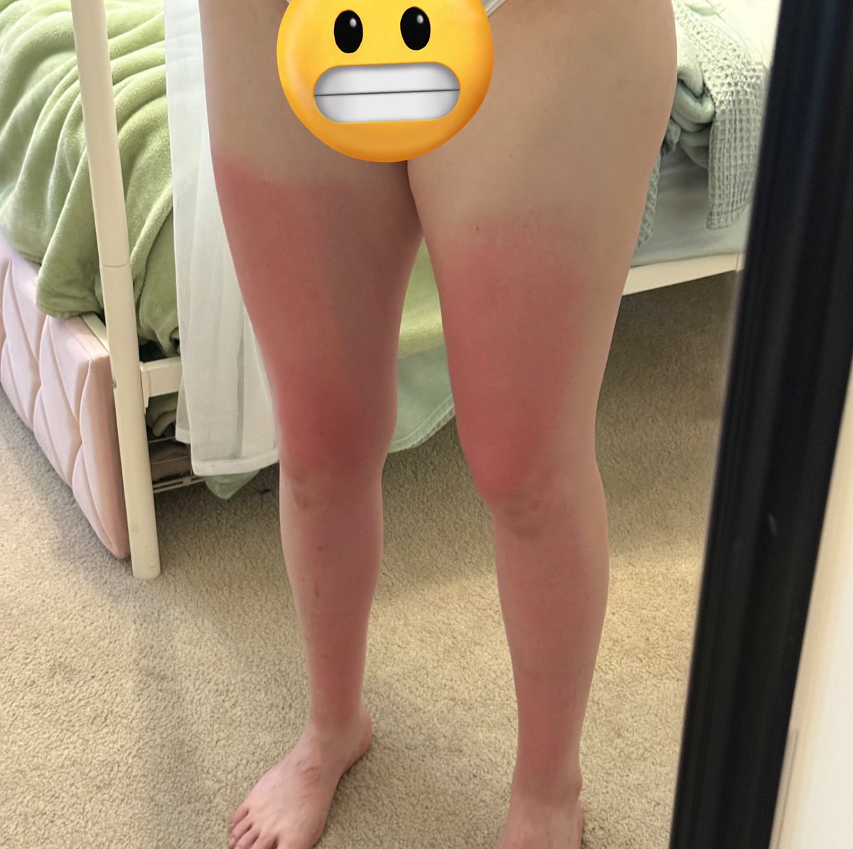 natts_2314's tweet photo. absolutely ROASTED my legs this weekend bc i forgot i spend all my time inside compared to how much i used to lmao.

now the game is just bathing in moisturizer so it doesn't peel and actually tans 😭😭😅 https://t.co/KSSG04FcJA