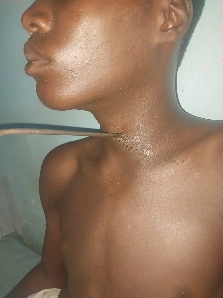 MuhammedSanity's tweet photo. Bashir Yana neman agajin gaggawa sakamakon soka mashi Karfe a wuya da masu kwacen waya sukayi masa a U/Kanawa, Nan take @B_ELRUFAI ya aika da kudin aikin don ayi mashi aiki.(Emergency Surgery).

Sannu da kokari JAGORA 
Allah yabiya Ka 

Bello Dai 2027 Ba chanji Da Yardar Allah https://t.co/hl7wuORx66