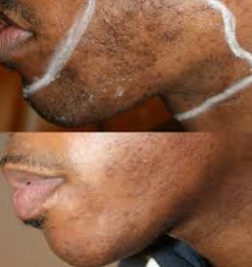ItsMrHealth's tweet photo. The process of removing unwanted dark colored hair from areas such as the face, legs, armpits, chest, or bikini area. 

Common methods include shaving, waxing, threading, depilatory creams, and laser hair removal...

The best hair removal method depends on an individual's skin type, hair characteristics, and overall health.

Always consult a qualified dermatologist or healthcare professional if you experience complications. 👨‍⚕️🩺