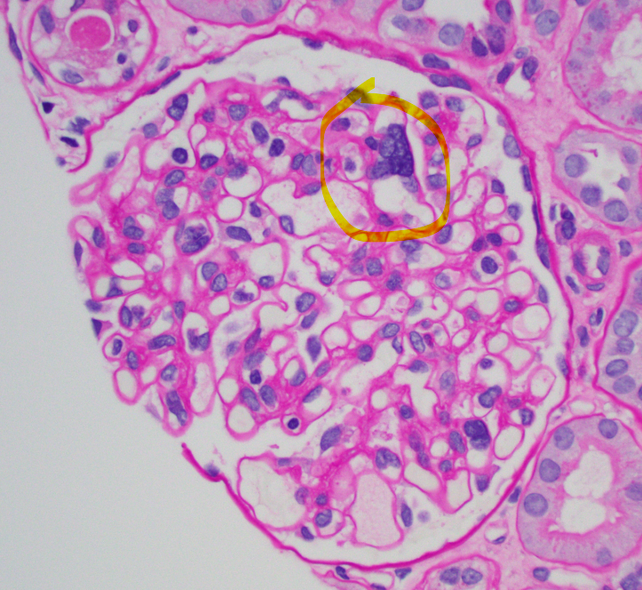JZRenalPath's tweet photo. Interesting finding of large multi-nucleated endothelial cells in a txp biopsy with chronic active AMR. IHC stain is ERG (endothelial cell marker). Probably just a manifestation of chronic endothelial cell injury in this setting #renalpath #pathtwitter #nephrology https://t.co/B5YdlrF3VY