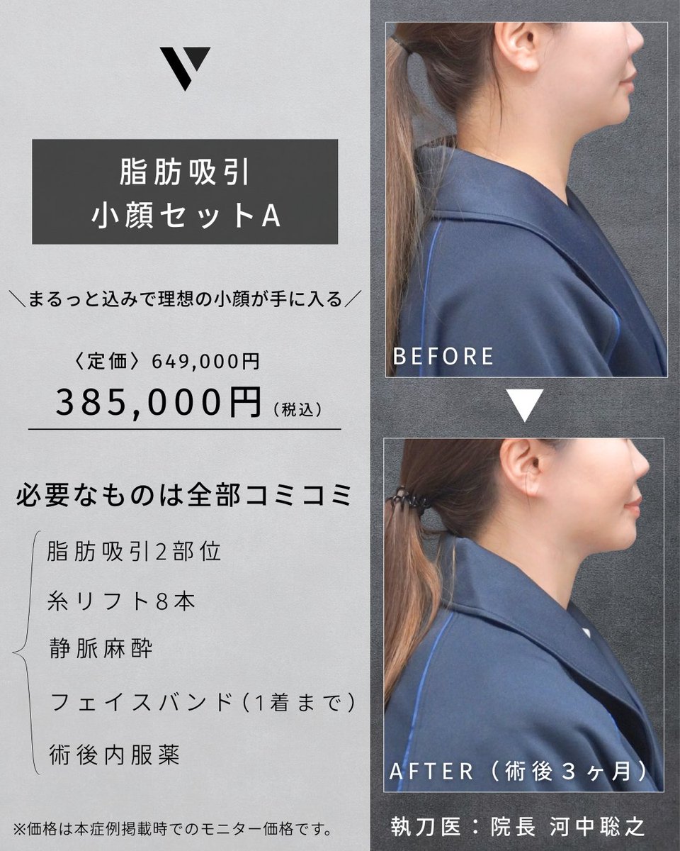 vertraclinic's tweet photo. 《 施術内容 》  
お顔の脂肪吸引  
吸引部位 ：顎下    

《 執刀医 》  
大阪院院長 河中 聡之(@Dr_kawanaka)    

《 詳細 》  
女性/30代/165cm/51kg https://t.co/VTXzlVUgIZ