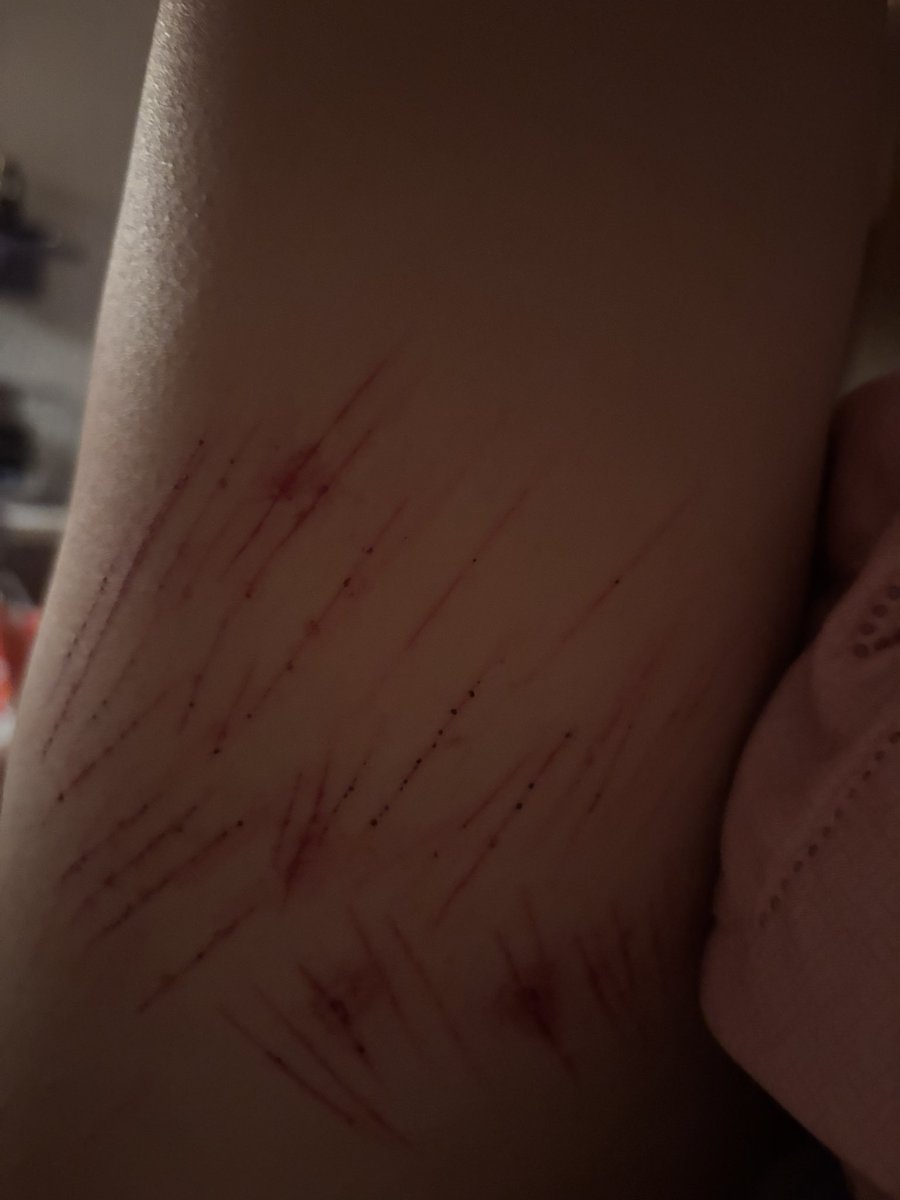 Zenwomu's tweet photo. Me corté en el muslo y me arde horrible 😭 https://t.co/URjqOk5EwV