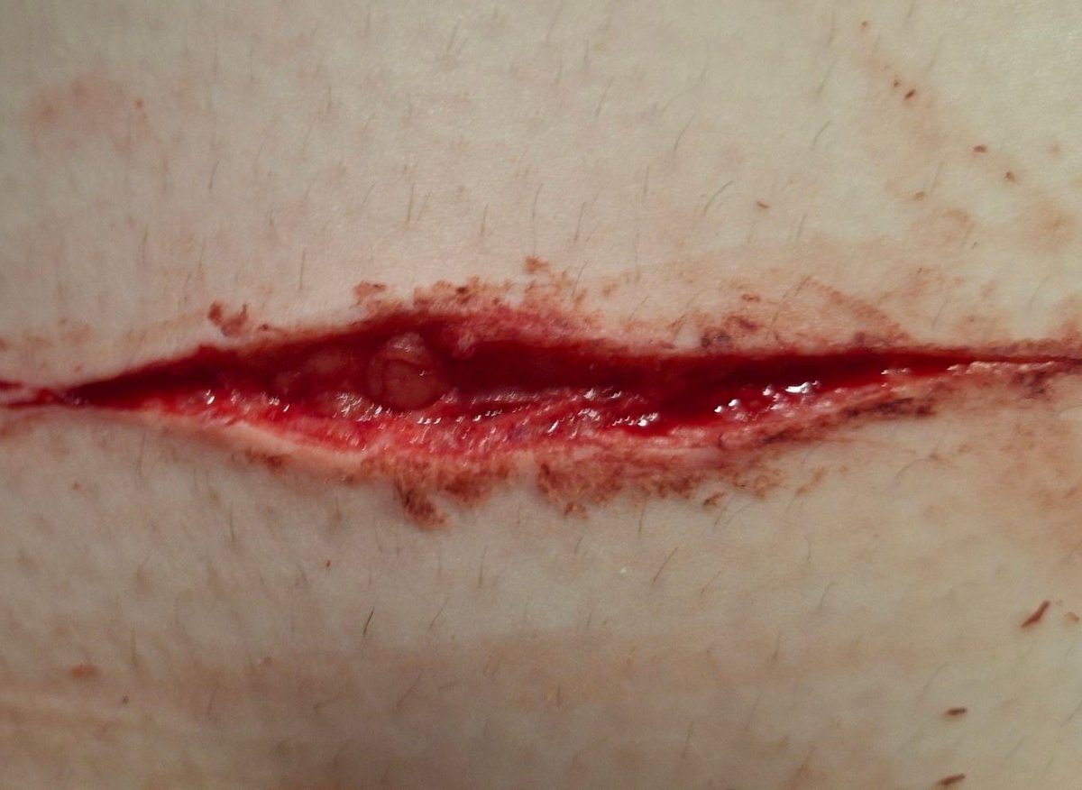 reinst4r_byers's tweet photo. 🫘 ⊹ ࣪ ˖ the cut vs the scar ⭑.ᐟ 2 months healed 🩸💉 #shtwt #shedtwt #988twt #moothunt #slitwt #ifb https://t.co/aoQm9sjncU