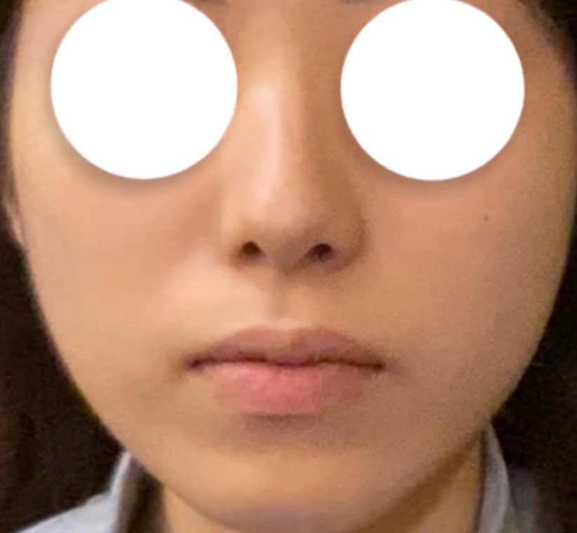 puppymjasmin's tweet photo. 鼻フル＋貴族手術DT20日目
中顔面が前に出たことでぐっと印象が変わった…でも鼻先の高さはそんなに出してないから横から見たらナチュラル！執刀医のセンス神だありがとう😭 https://t.co/4Tw5irUlwJ