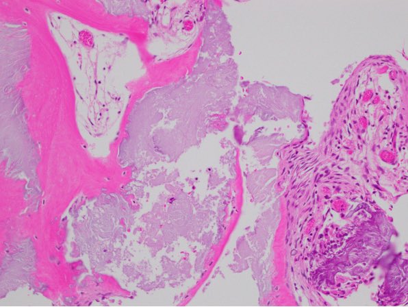 neuropathology's tweet photo. ⭐️AANP Case of the Month⭐️
Credit: Drs. Maryam Abdo &amp; Nelli S Lakis @KUPathology
62M with intractable seizures. MRI: calcified mass in centrum semiovale. Histology shown. DDX? Final #diagnosis? What is standard #treatment?
#neuropath #PathX https://t.co/CTai5Bt6tS